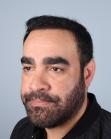 After Hair Transplant&nbsp;2 Sessions (Areas)